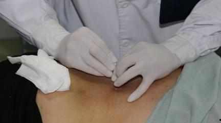 臀大肌针刀视频,臀大肌针刀治疗技巧解析与实操演示