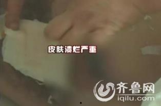 艾灸治病视频,传统养生与疾病治疗的现代实践