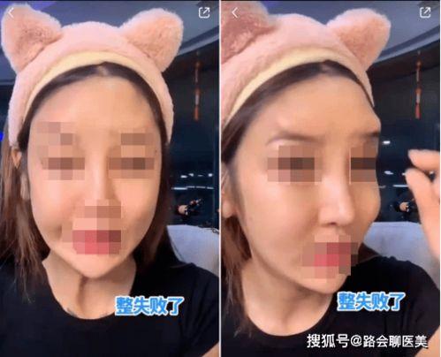 玻尿酸填充额头视频,轻松打造立体美颜秘诀